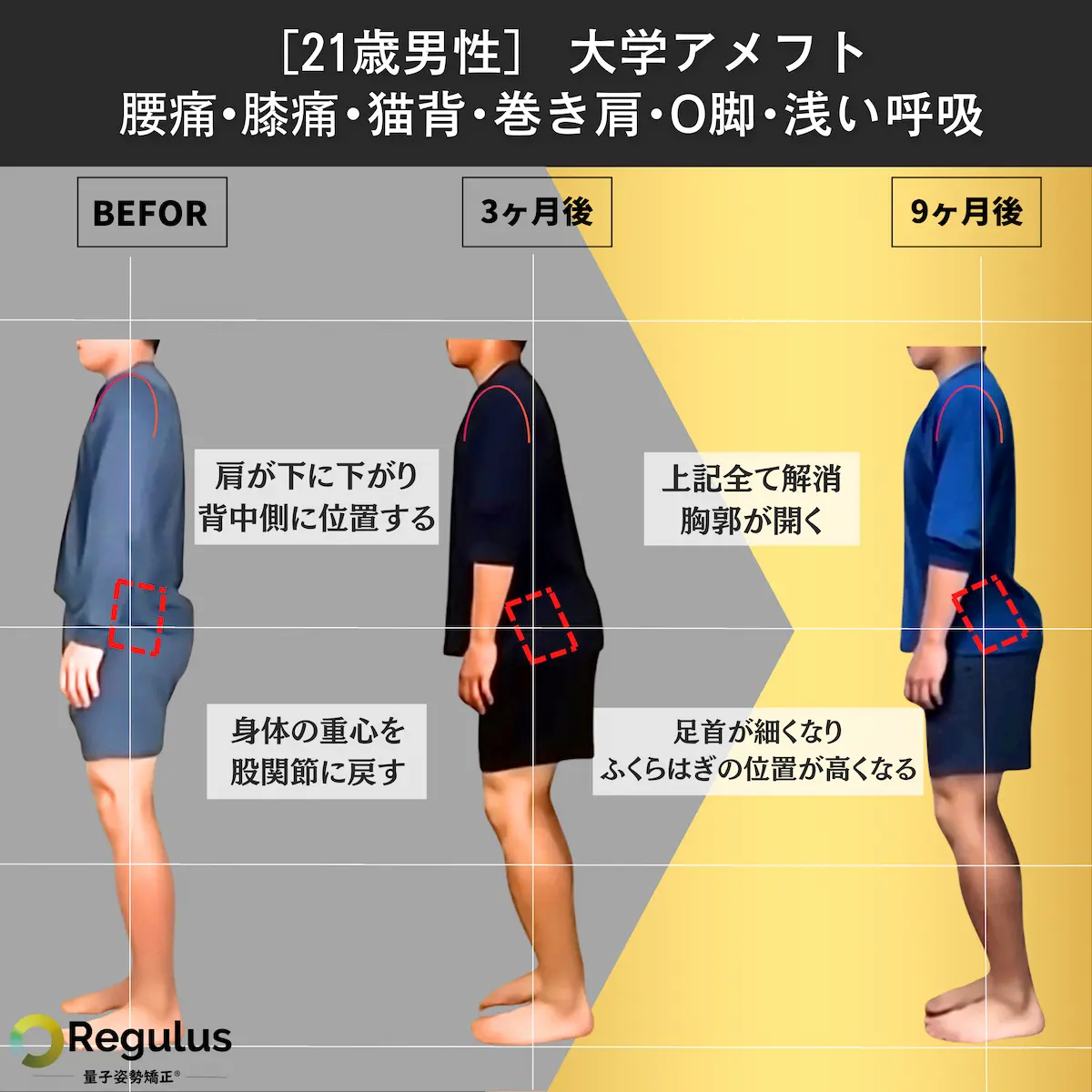 [21歳男性]大学アメフト　腰痛・膝痛・猫背・巻き肩・O脚・浅い呼吸
