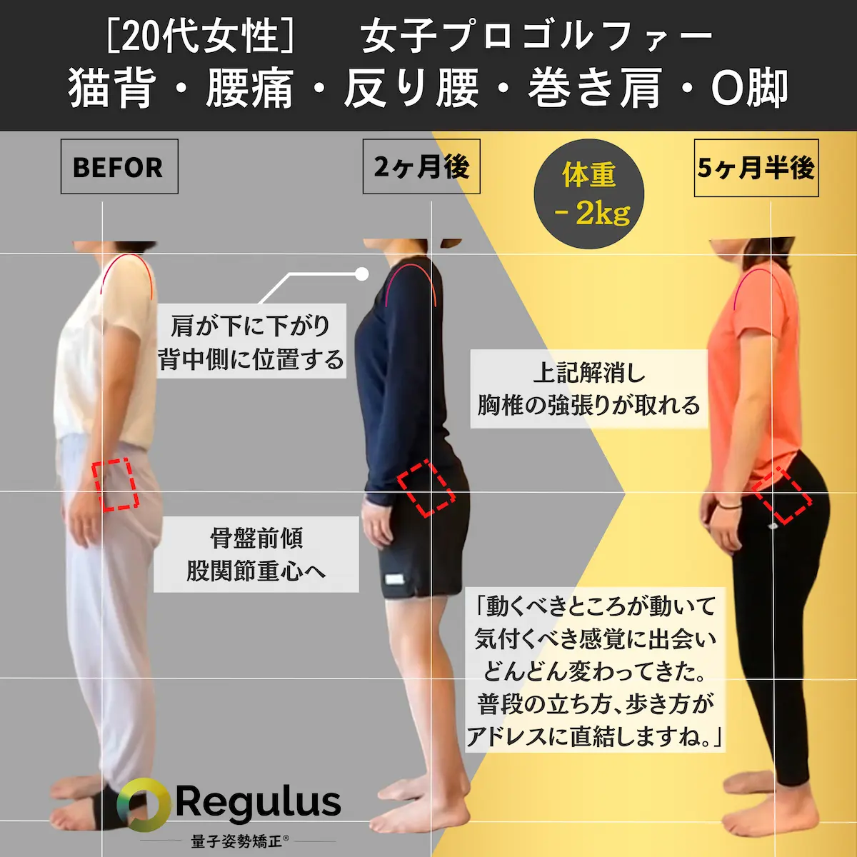 [20代女性]女子プロゴルファー　猫背・腰痛・反り腰・巻き肩・O脚