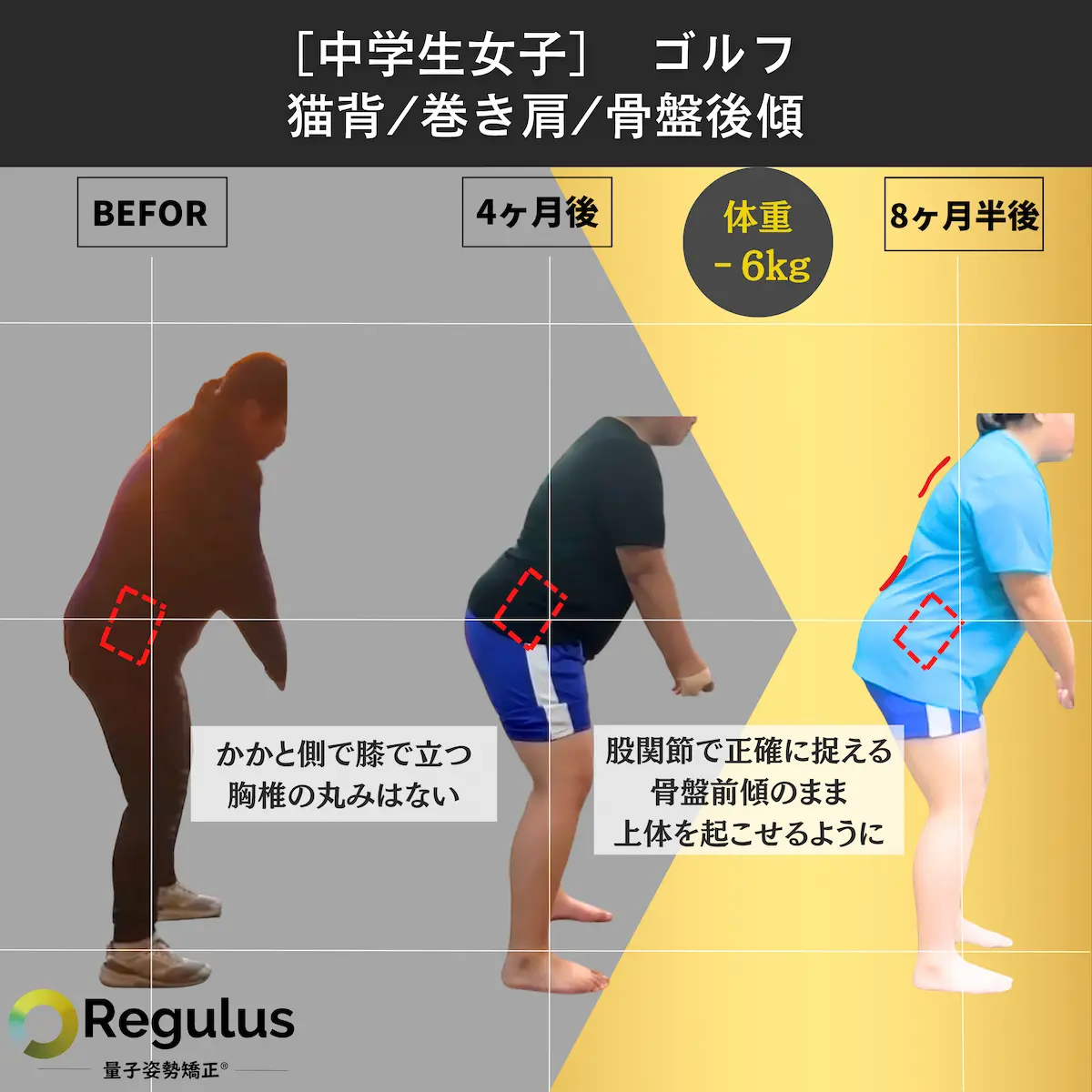 [中学生女子]ゴルフ　猫背／巻き肩／骨盤後傾